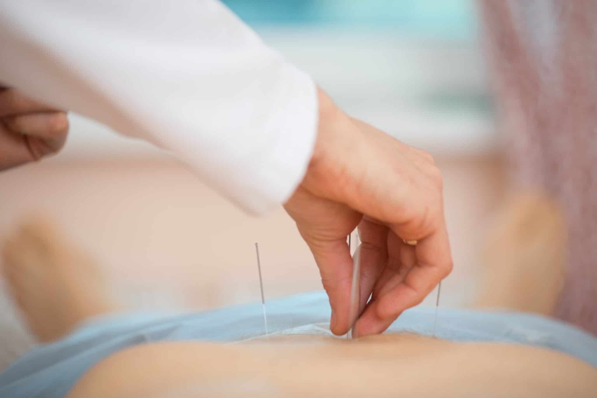 Indsættelse af akupunkturnåle i patient