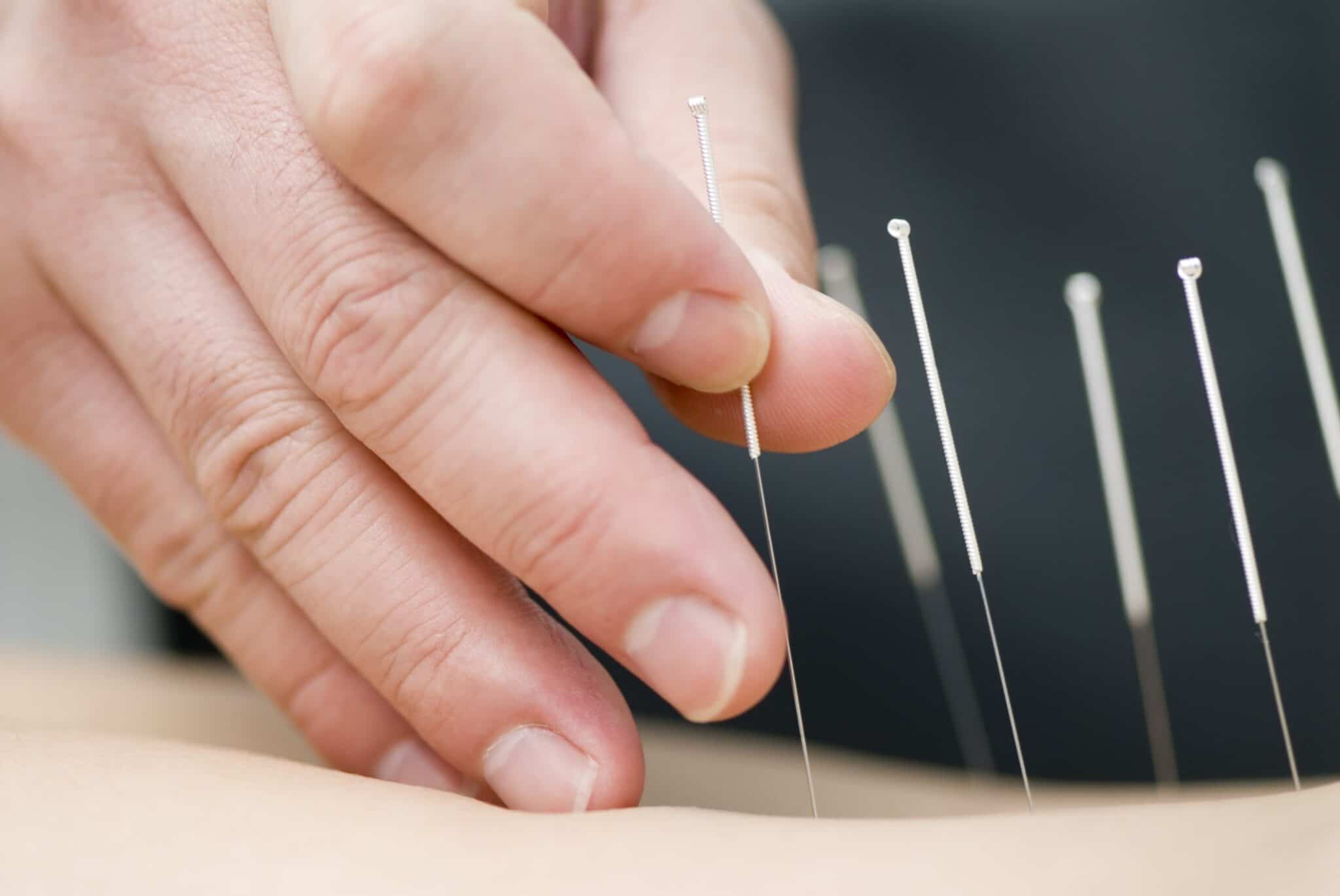Indsættelse af akupunkturnåle i patient - tæt på